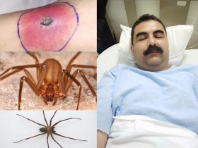 Investiga la CDH de Puebla presunta negligencia médica en muerte de bombero por picadura de araña violinista