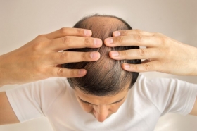 1 de cada 2 hombres de entre 20 y 30 años tiene alopecia androgenética.