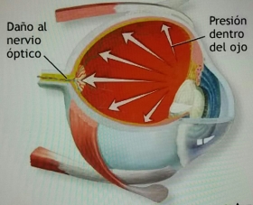 El glaucoma crónico es considerado como el enemigo silencioso porque no da síntomas en su etapa inicial 
